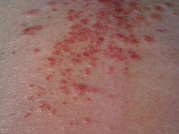 发生湿疹时,初起于两颊,发生红斑,境界不清,红斑上密集针尖大丘疹,丘