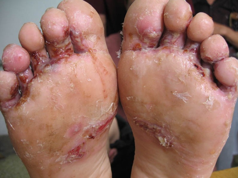 医生团队  脚气的病因与治疗脚气是一种极常见的真菌感染性皮肤病.
